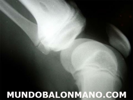 LESION-RODILLA-MUNDOBALONMANO.COM-2