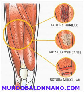 ROTURA-DISTENSION-MUSCULAR-MUNDOBALONMANO.COM